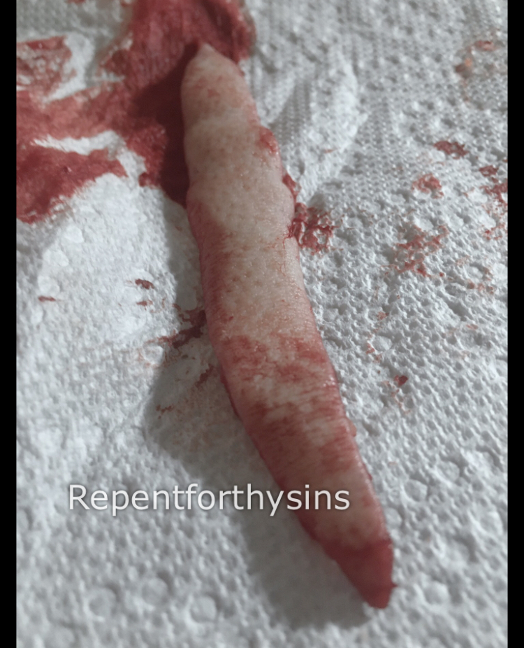 Flesh removed from my body.