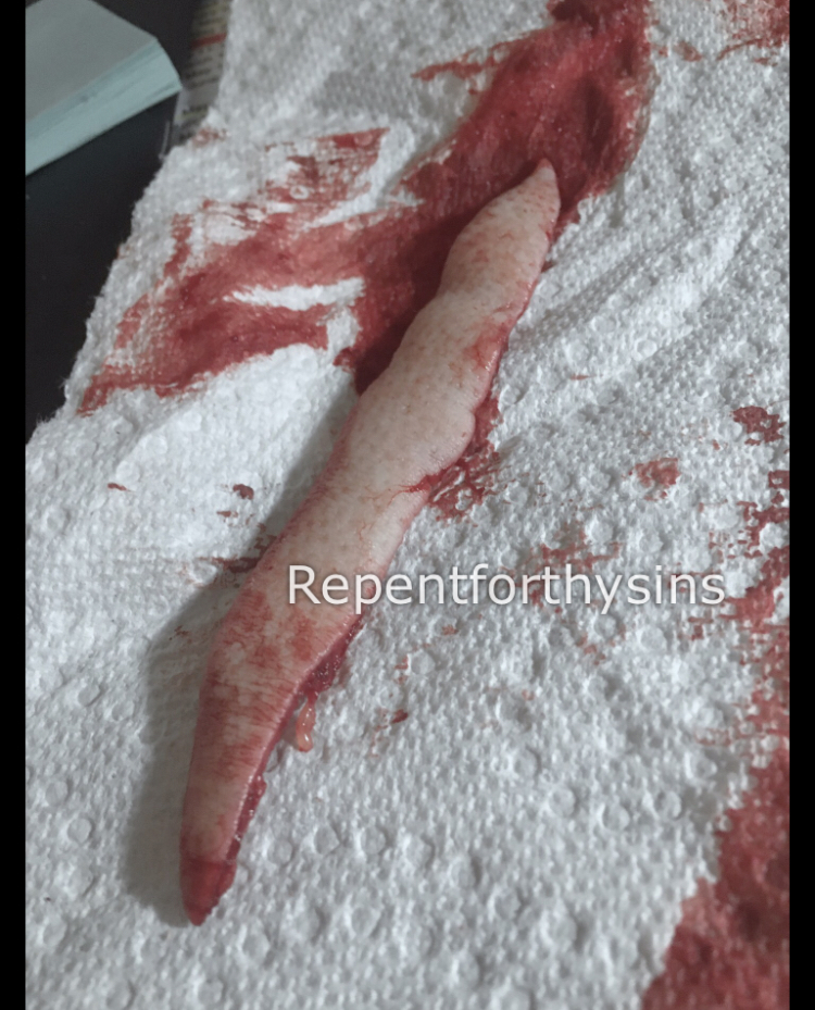 Flesh removed from my body.