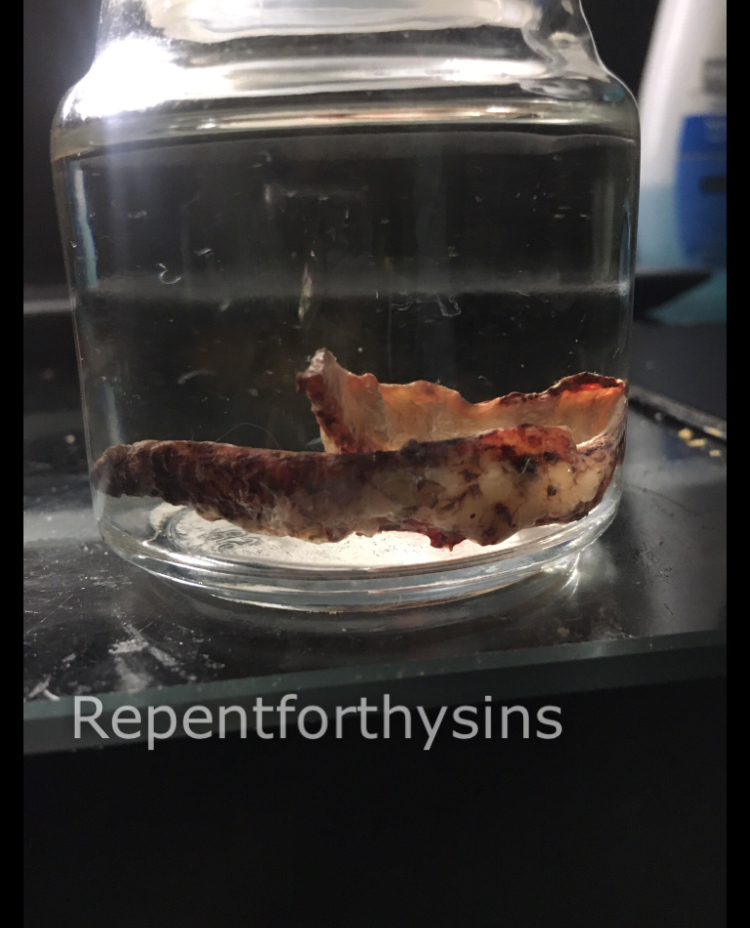 Flesh removed from my body.