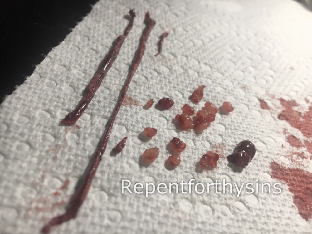 Flesh removed from my body.