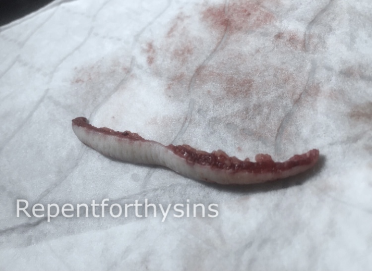 Flesh removed from my body.