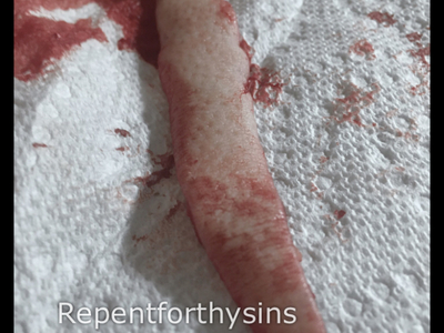 Flesh removed from my body