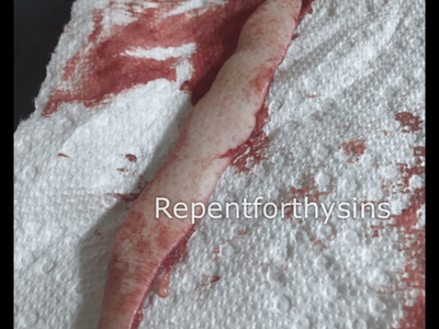 Flesh removed from my body.