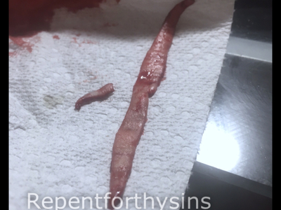 Flesh removed from my body