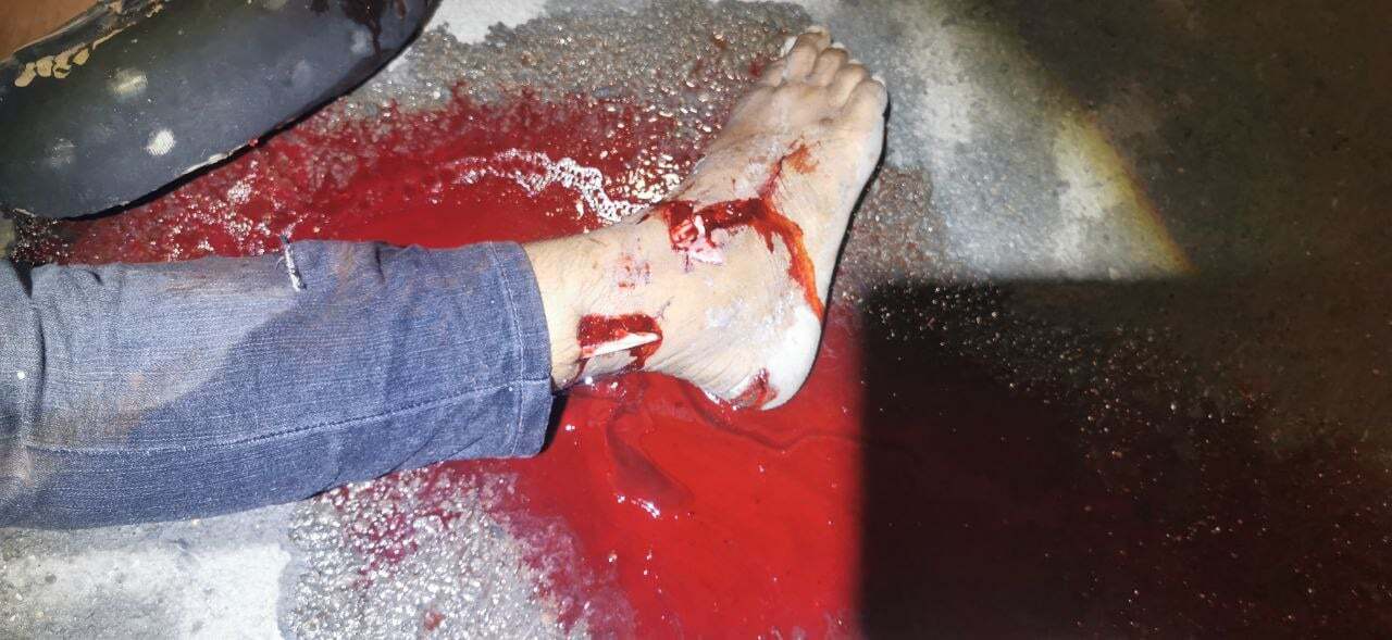 Teen on a Motorbike Collided with an Electric Tricycle