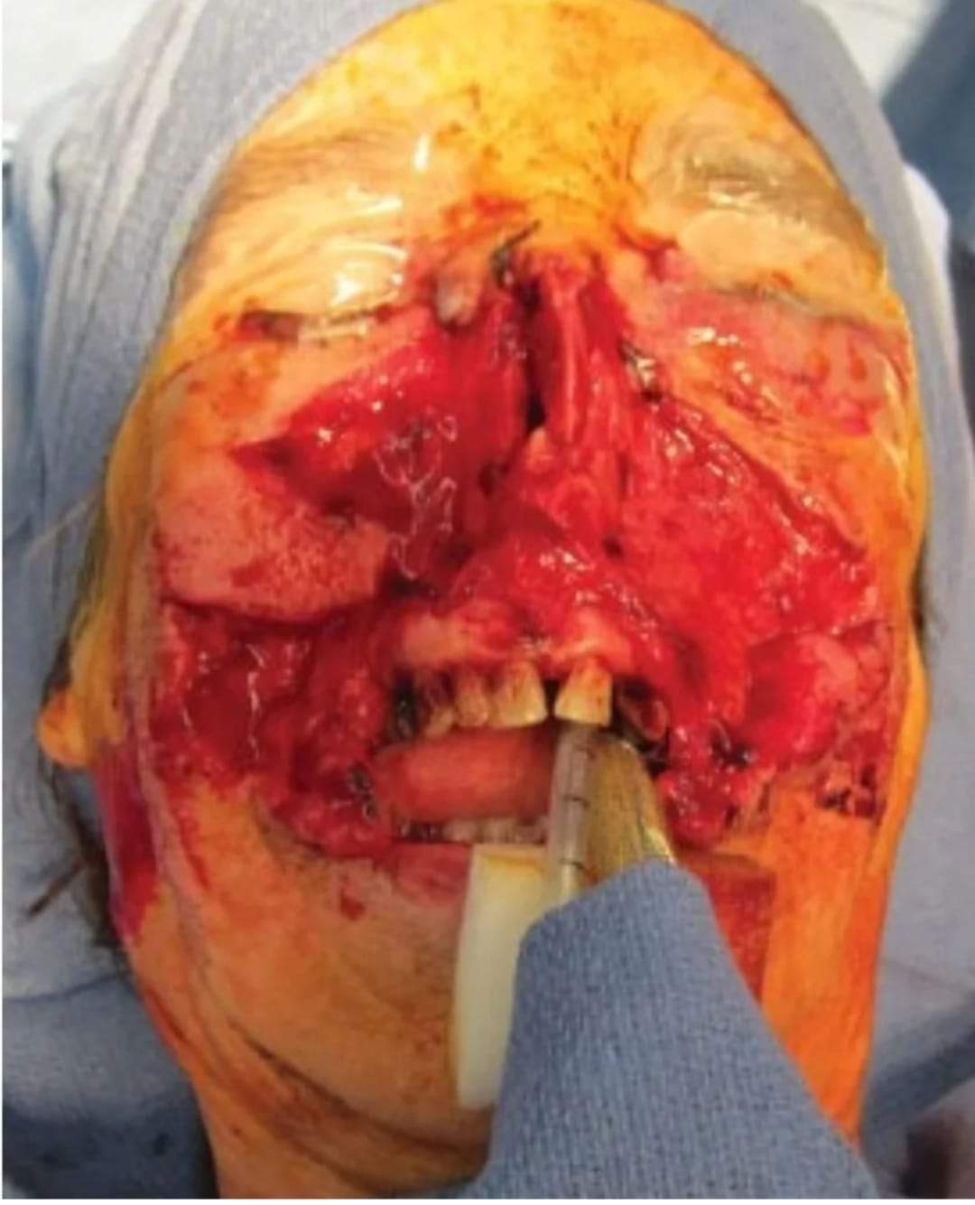 71-year-old female patient who sustained a severe midface soft tissue