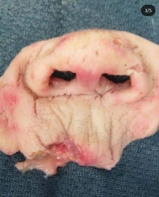 71-year-old female patient who sustained a severe midface soft tissue