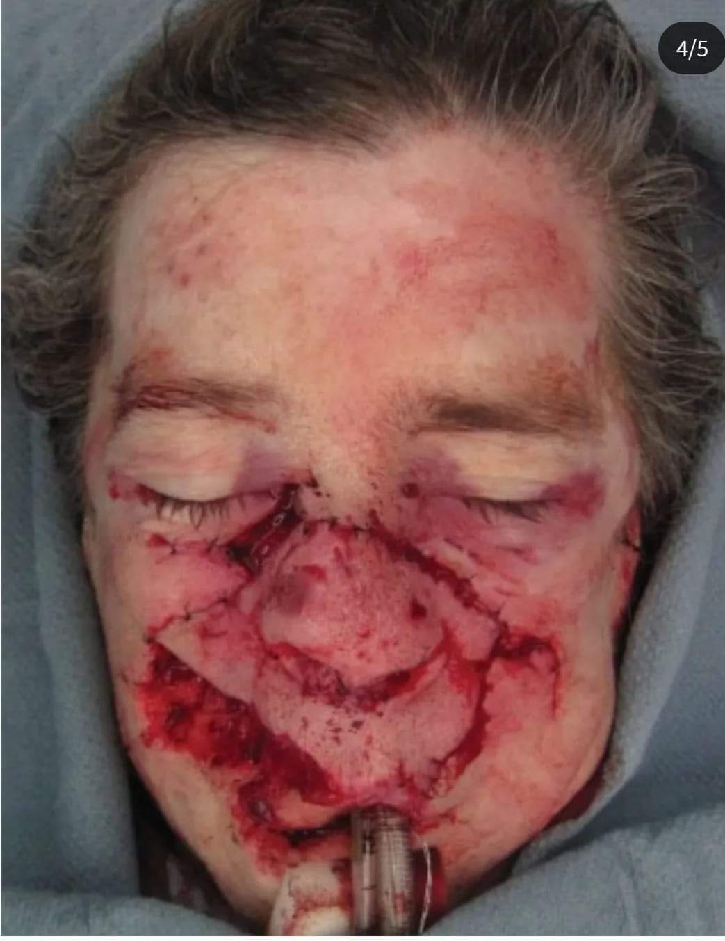 71-year-old female patient who sustained a severe midface soft tissue