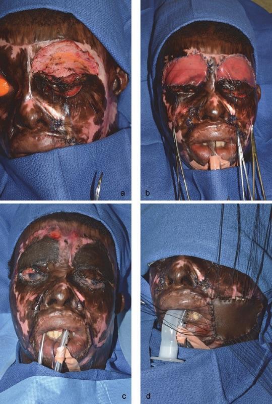 Liberia: Acid attack due to refusal of marriage.