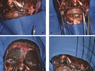 Liberia: Acid attack due to refusal of marriage.