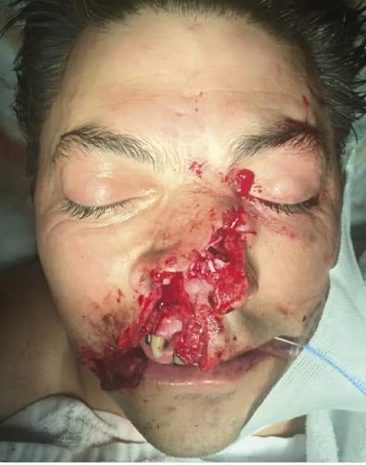 Angle Grinder Accident