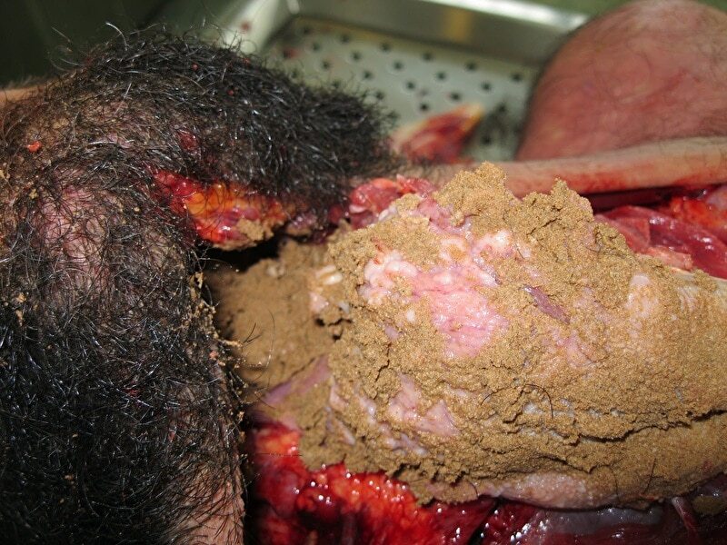 Autopsy of Man Who Suffocated in a Ditch