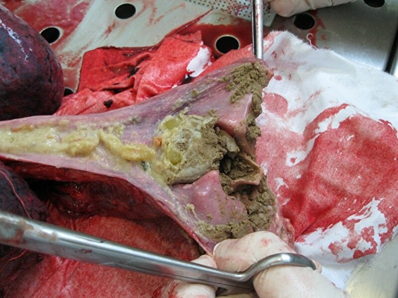 Autopsy of Man Who Suffocated in a Ditch