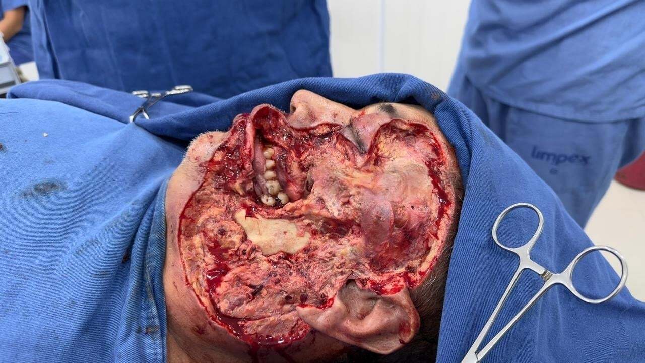 Brazil- Naldo suffered from a necrotizing skin condition died at 30.