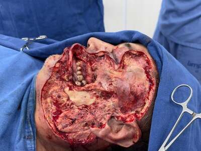 Brazil- Naldo suffered from a necrotizing skin condition died at 30.