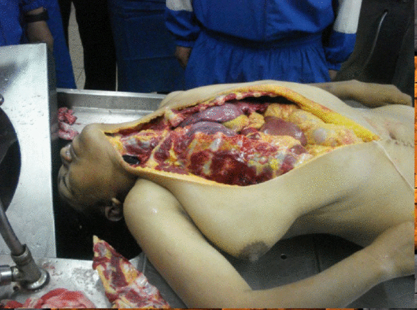 Female autopsy in Brazil