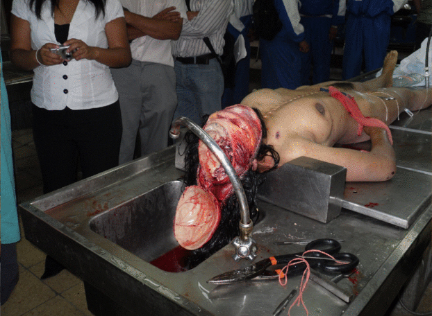 Female autopsy in Brazil