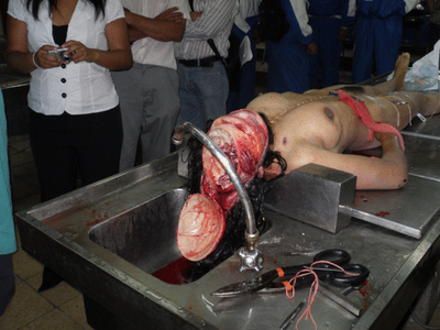 Female autopsy in Brazil 