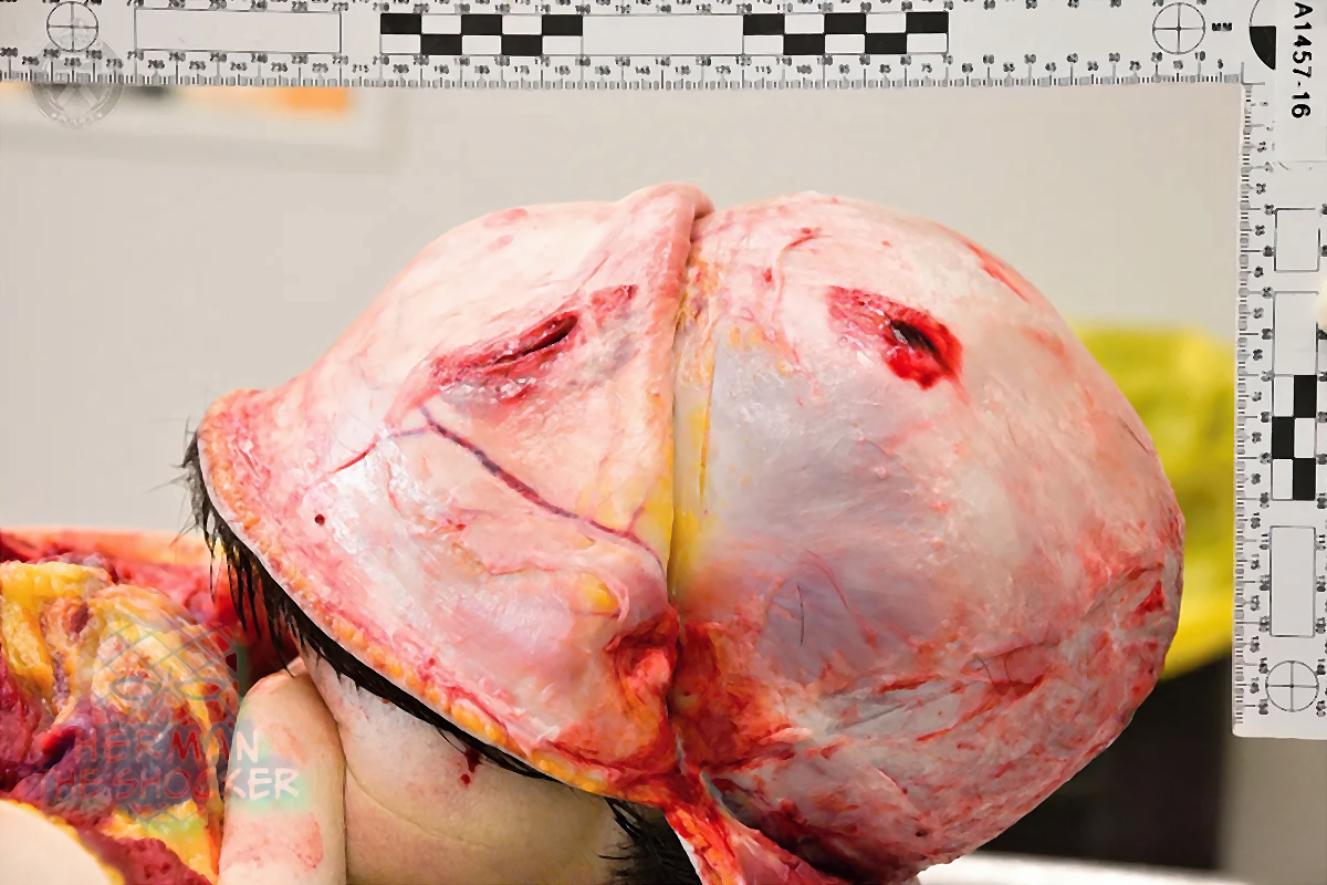 Fatal Bleeding From A Laceration Of Superficial Temporal Artery