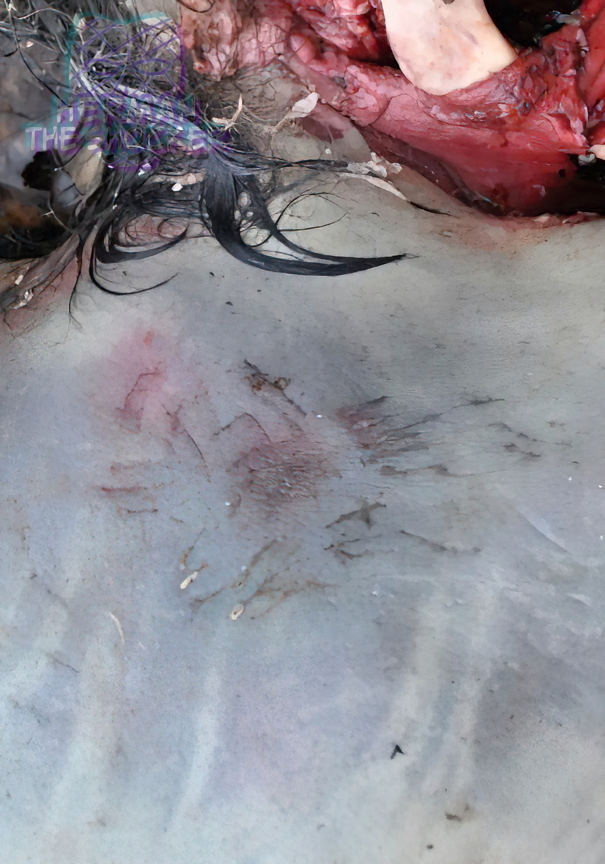 Raccoon Scavenging On A Human Corpse