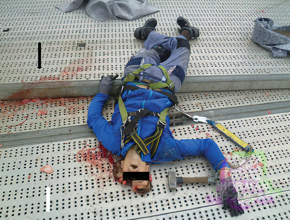 Head Split Open After Fall From Ferris Wheel