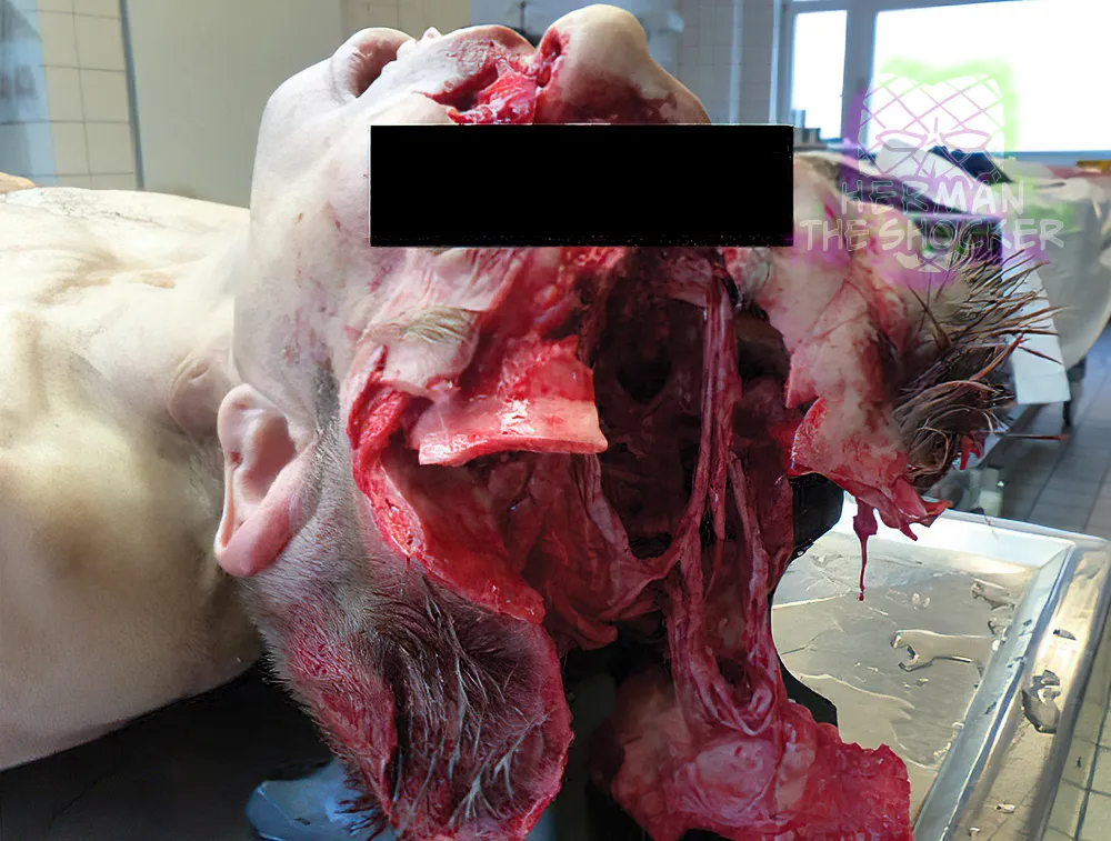 Head Split Open After Fall From Ferris Wheel