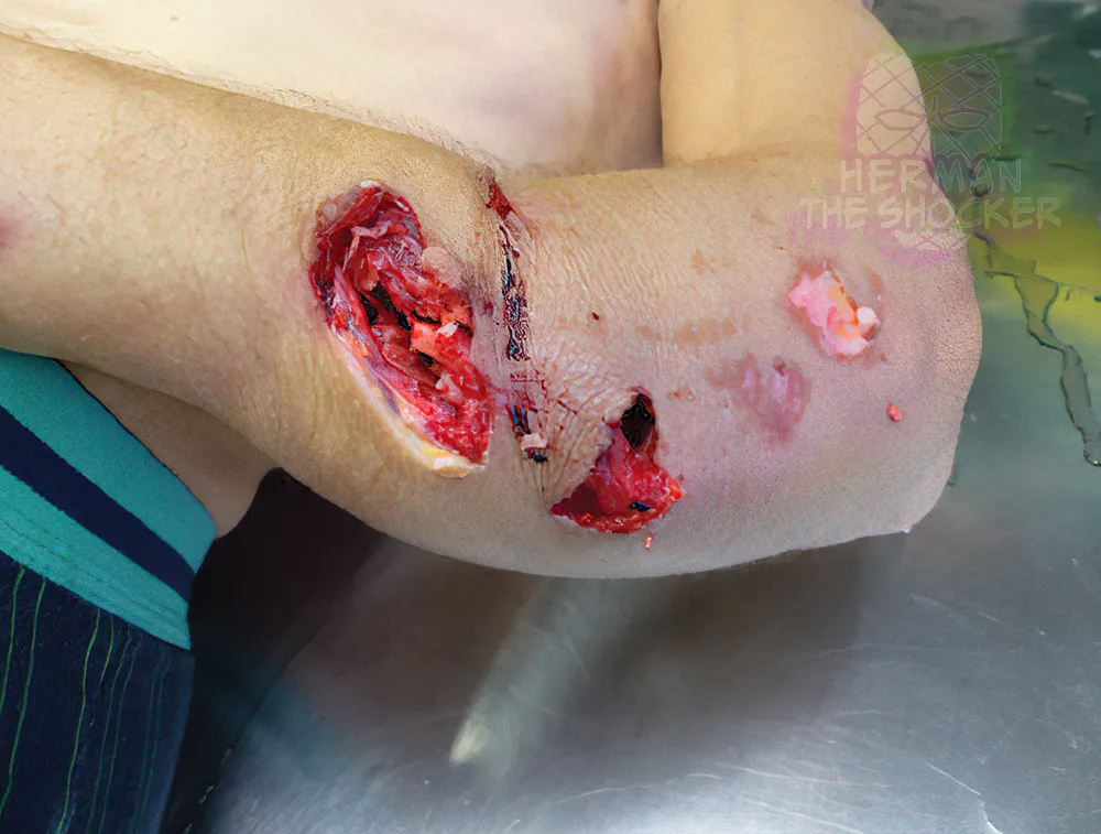 Head Split Open After Fall From Ferris Wheel