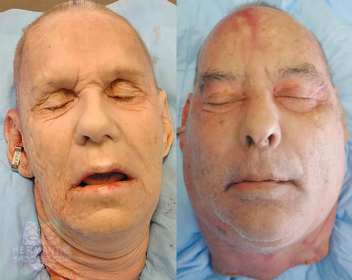 WTF: Facial Allograft Technique In Facial Reconstruction