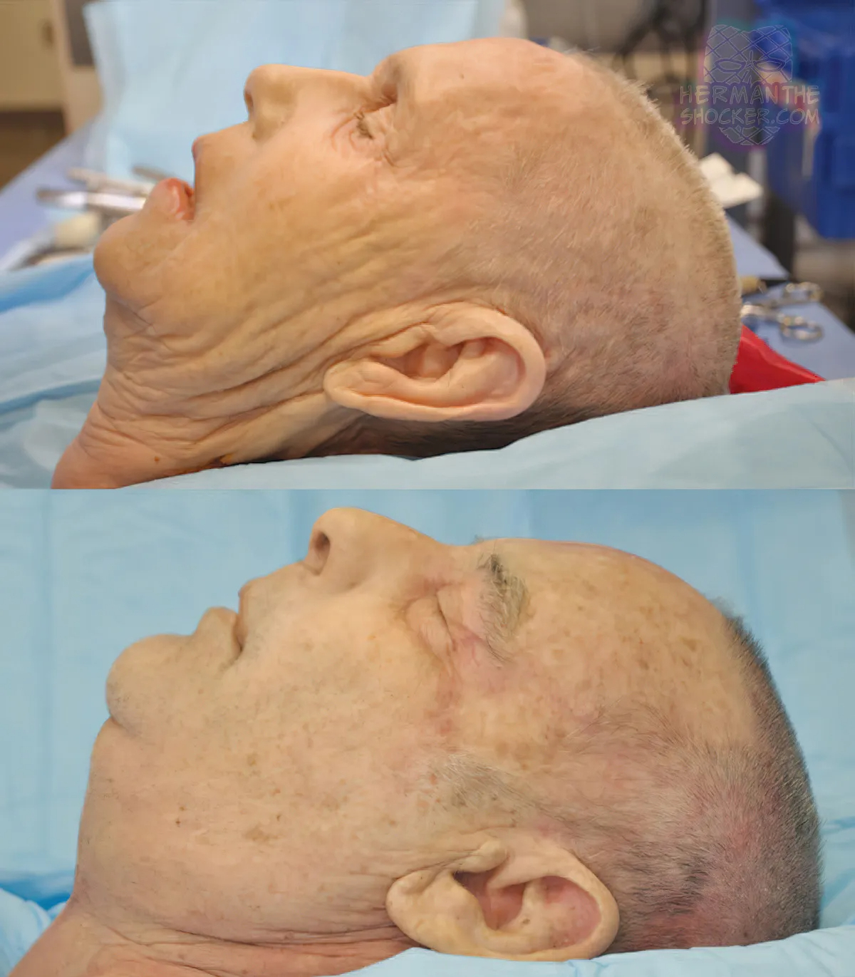 WTF: Facial Allograft Technique In Facial Reconstruction