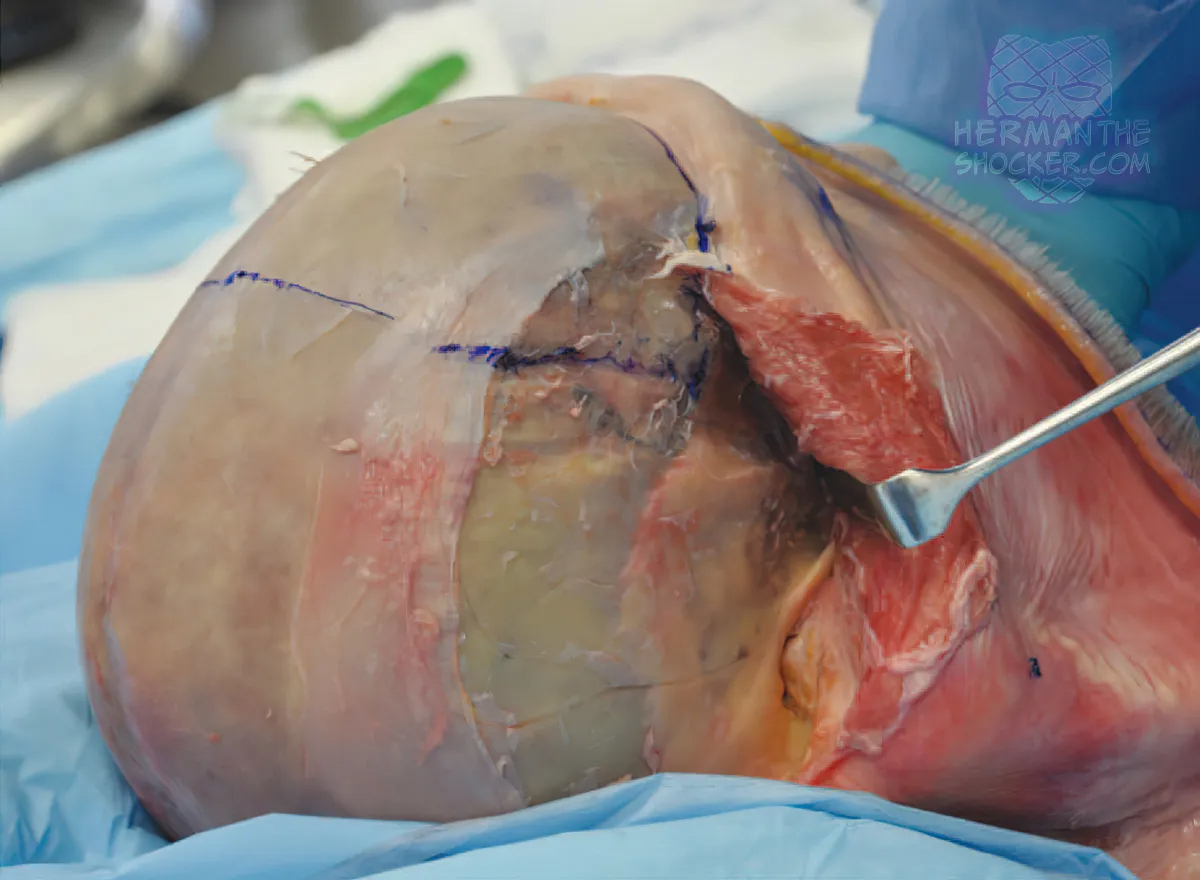 WTF: Facial Allograft Technique In Facial Reconstruction