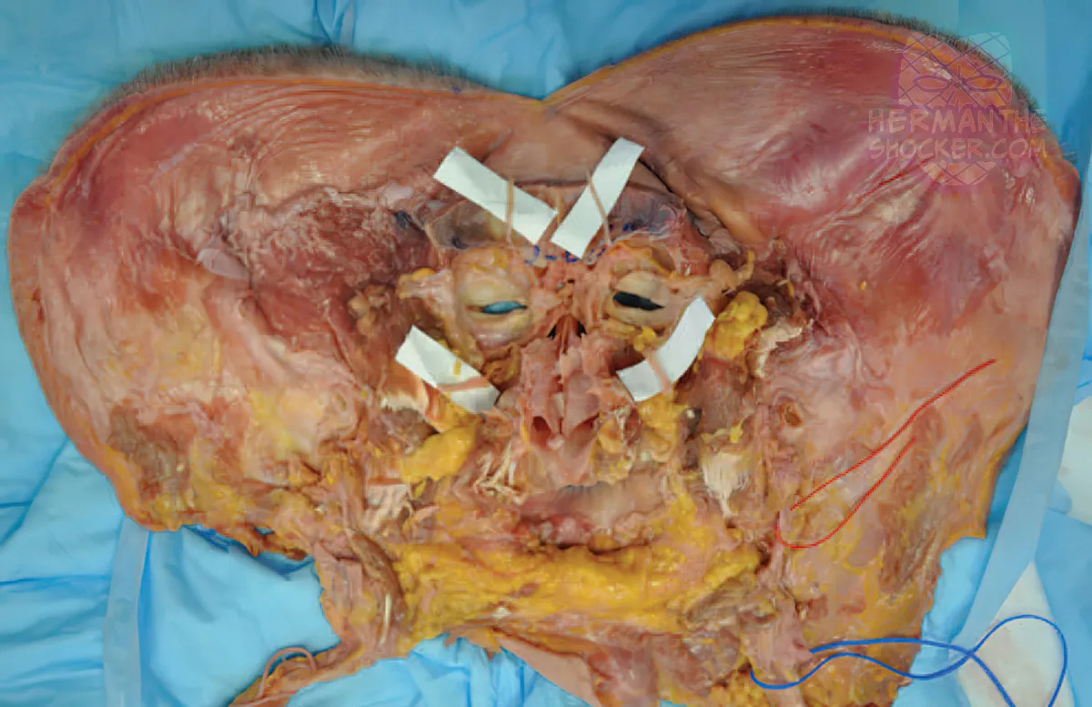 WTF: Facial Allograft Technique In Facial Reconstruction