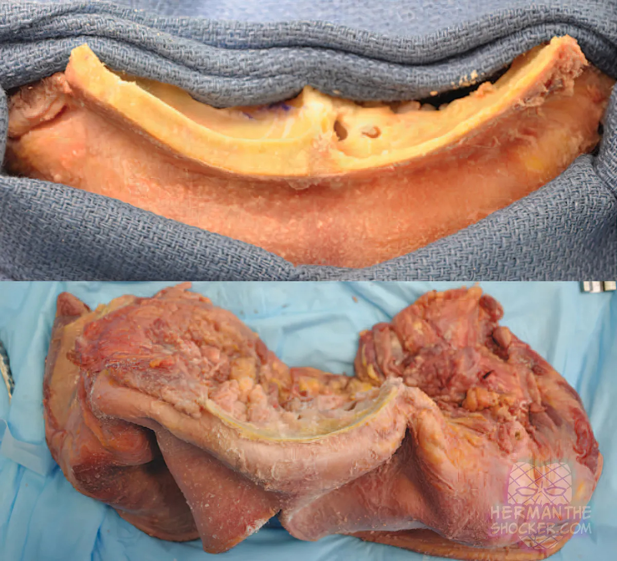 WTF: Facial Allograft Technique In Facial Reconstruction