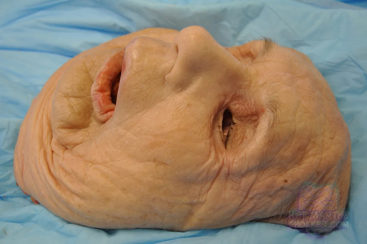 WTF: Facial Allograft Technique In Facial Reconstruction