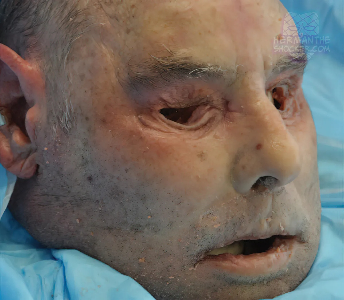 WTF: Facial Allograft Technique In Facial Reconstruction