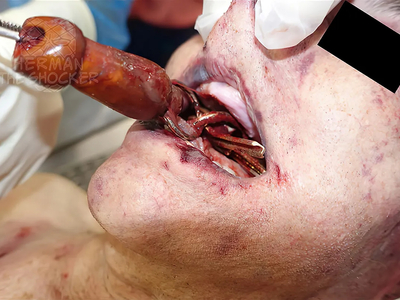 Patricide And Overkill