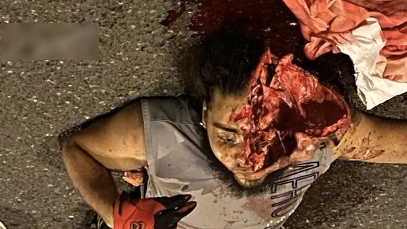 Dude cracks skull in motorcycle accident