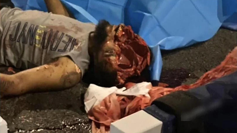 Dude cracks skull in motorcycle accident