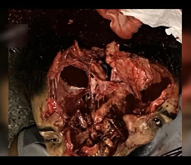 Dude cracks skull in motorcycle accident