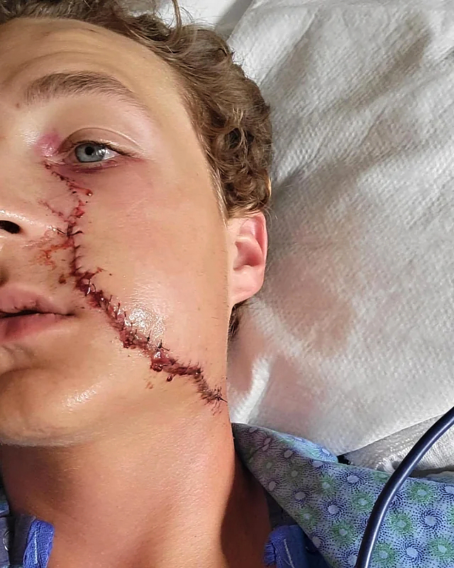 He survived a serious facial injury from a circular saw