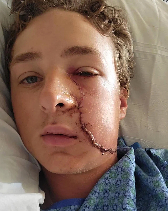 He survived a serious facial injury from a circular saw