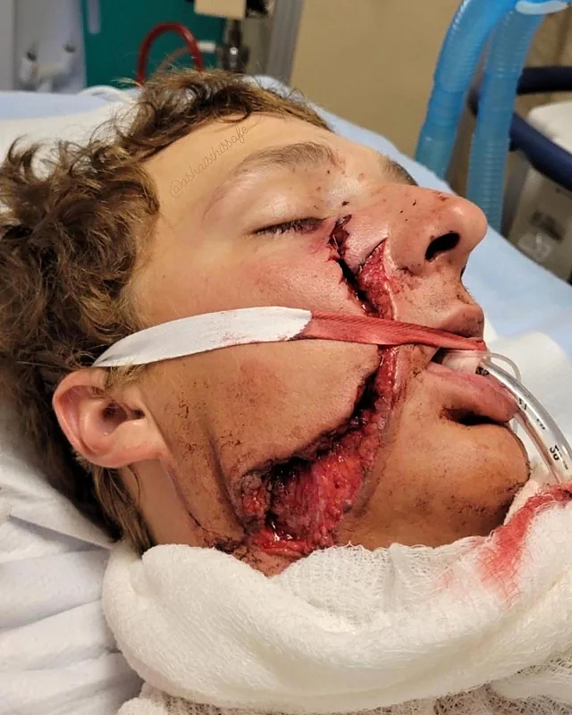 He survived a serious facial injury from a circular saw