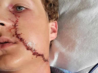 He survived a serious facial injury from a circular saw