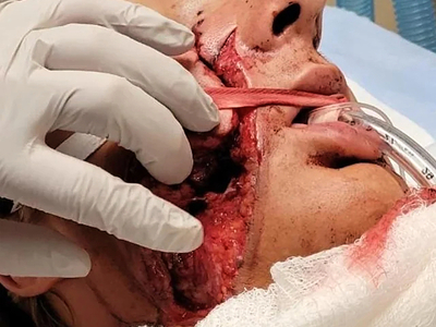 He survived a serious facial injury from a circular saw