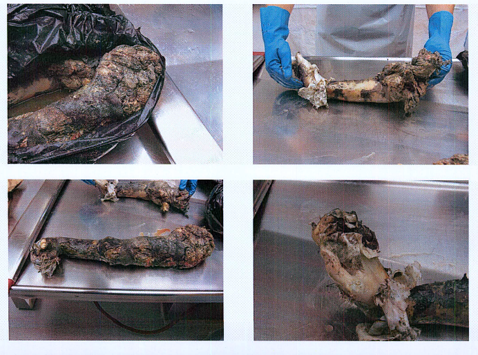 Autopsy images from Christian Larsson case