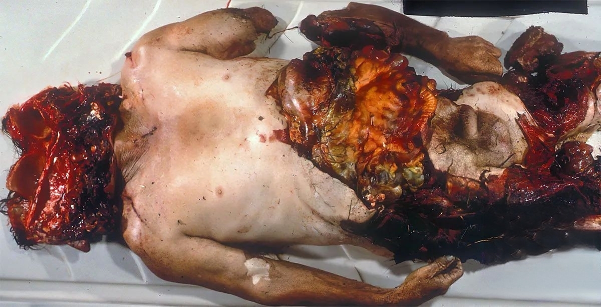 Fatal Chop Injuries After Falling Off A Tractor