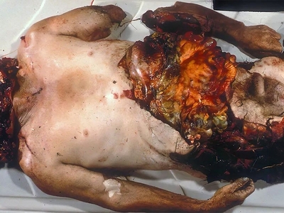 Fatal Chop Injuries After Falling Off A Tractor