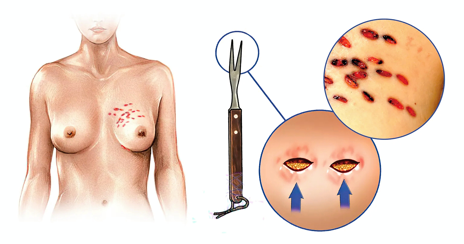Multiple Stab Wounds Into Chest With Barbecue Fork