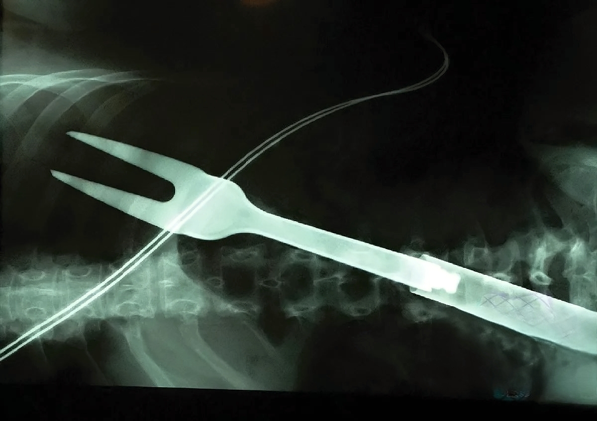 Multiple Stab Wounds Into Chest With Barbecue Fork