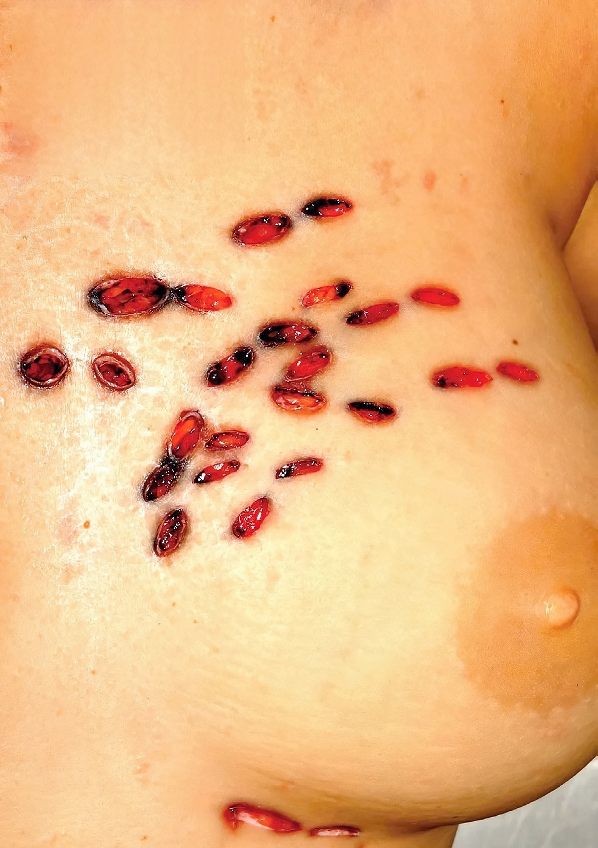 Multiple Stab Wounds Into Chest With Barbecue Fork