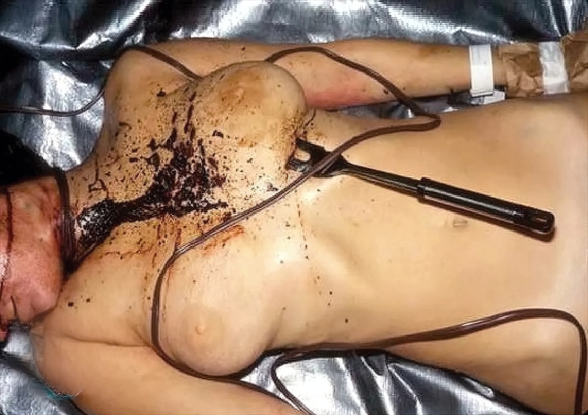 Multiple Stab Wounds Into Chest With Barbecue Fork